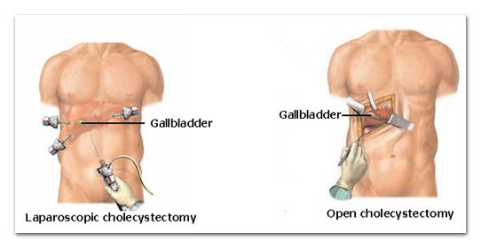 what is gall bladder