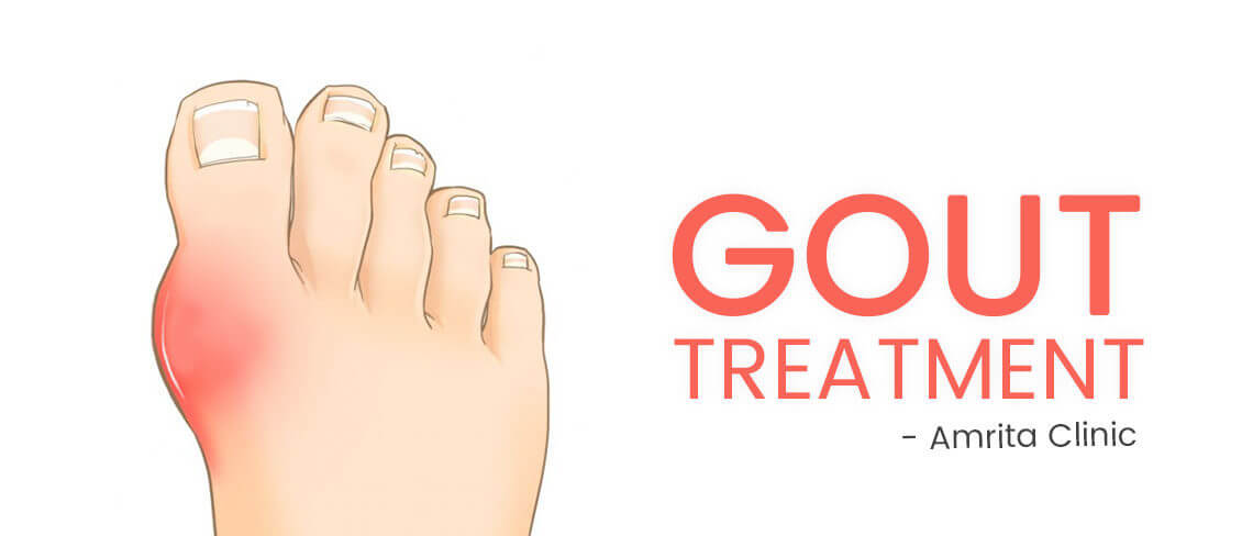 Treatment gout Gout Remedies: